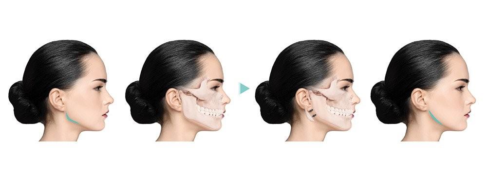 JAW REDUCTION SURGERY