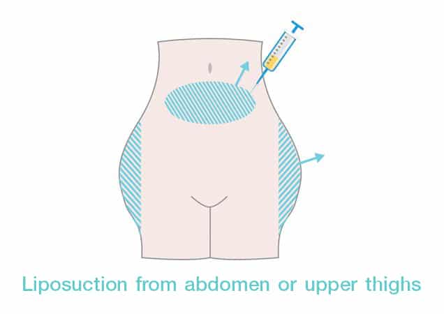 Liposuction form abdomen or upper thighs