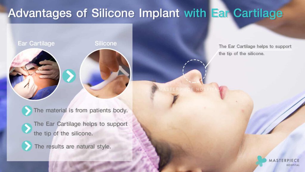 Advantages-of-Silicone-Implant-with-Ear-Cartilage