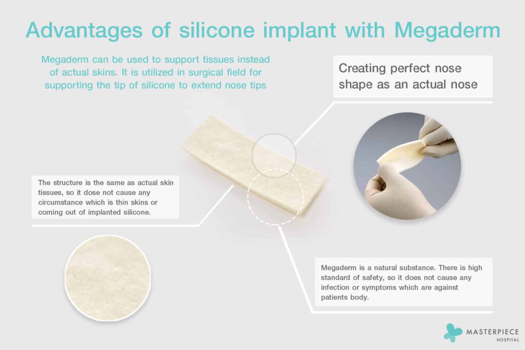 Advantages-of-silicone-implant-with-Megaderm