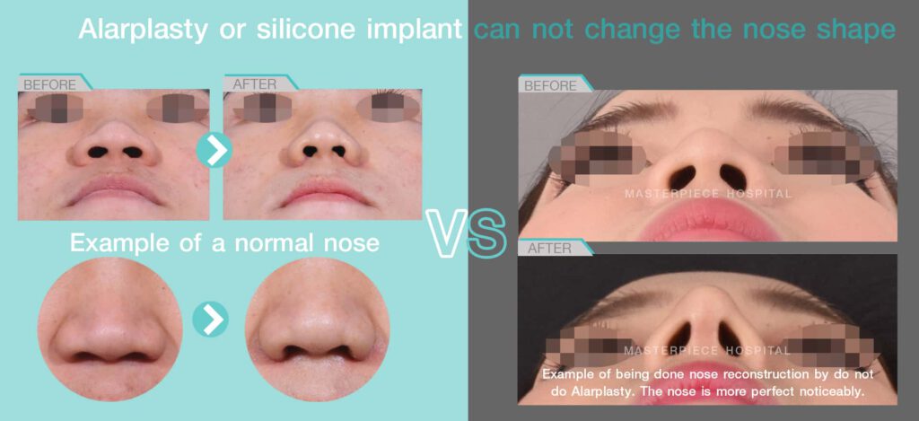 Alarplasty or silicone implant can not chang the nose shape