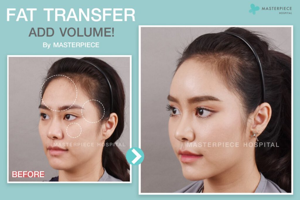 review fat transfer 2