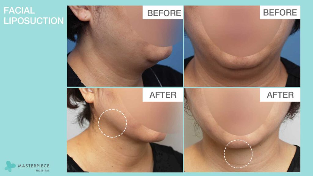 Review Facial liposuction 2