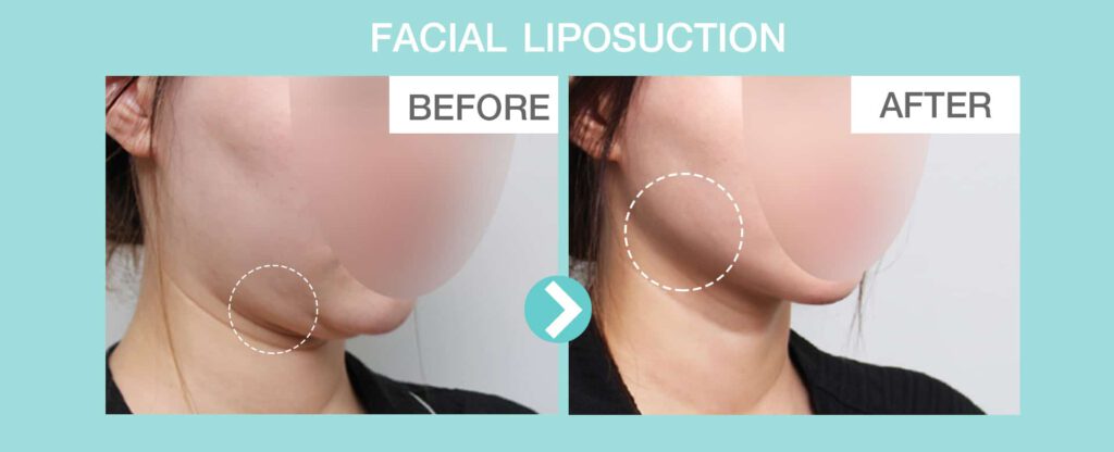 Review Facial liposuction 
