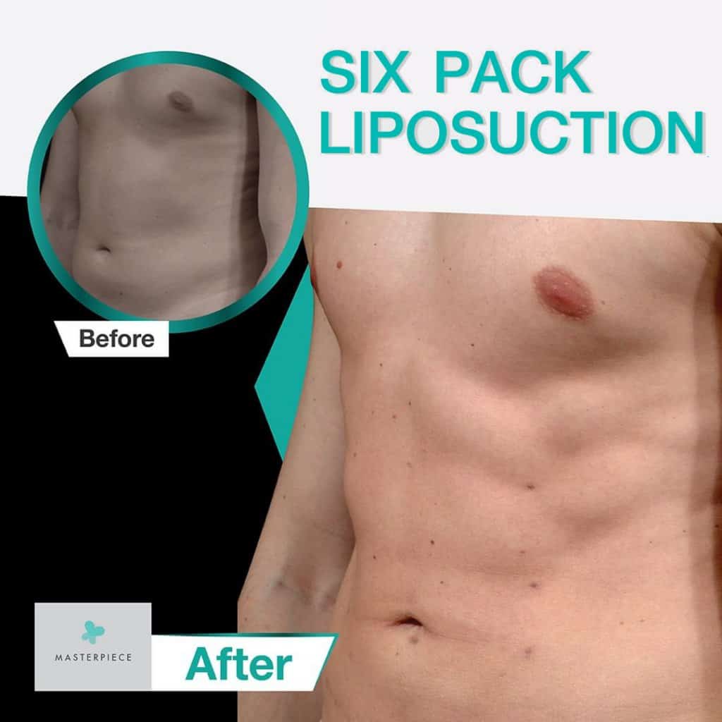 six pack liposuction 