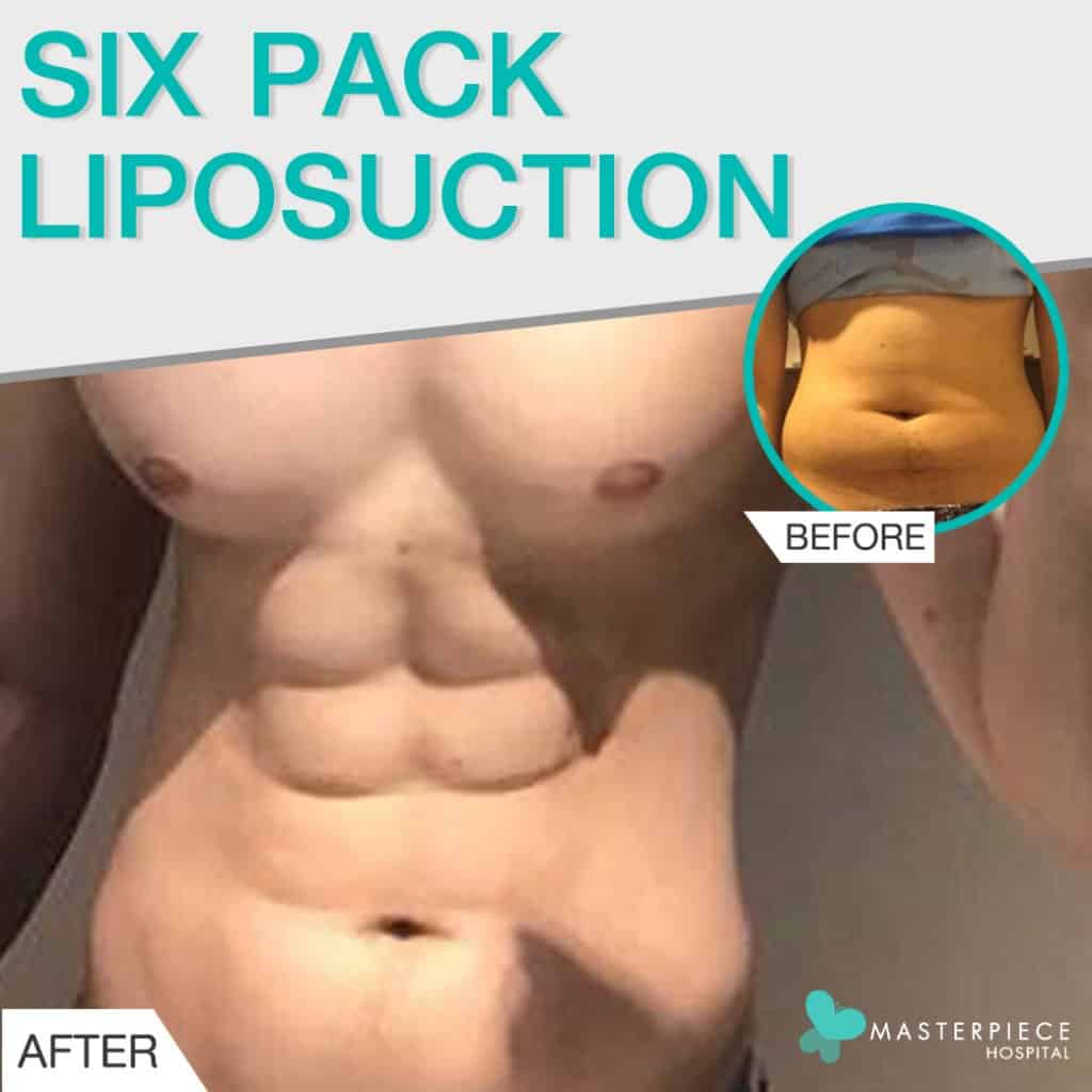 six pack liposuction  1