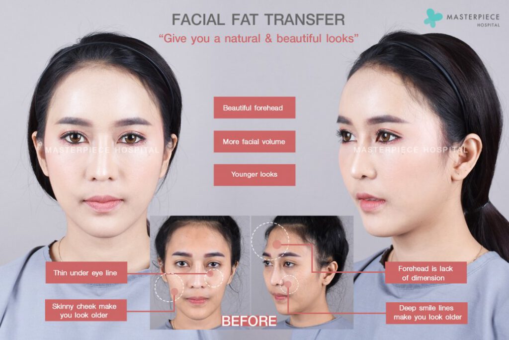 facial fat transfer give you a natural&beautful looks