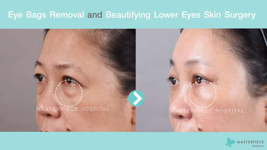 Eye bags removal and beautifying lower Eyes Skin Surgery