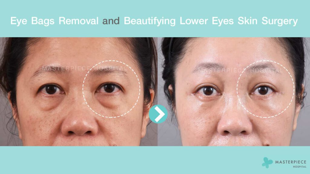 Eye bags removal and beautifying lower Eyes Skin Surgery 1