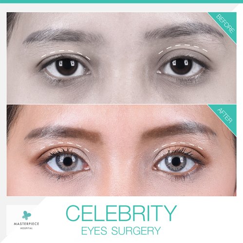 review celebrity eyes surgery 1