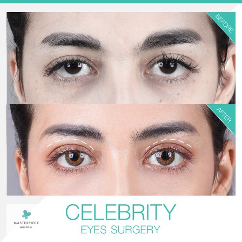 review celebrity eyes surgery