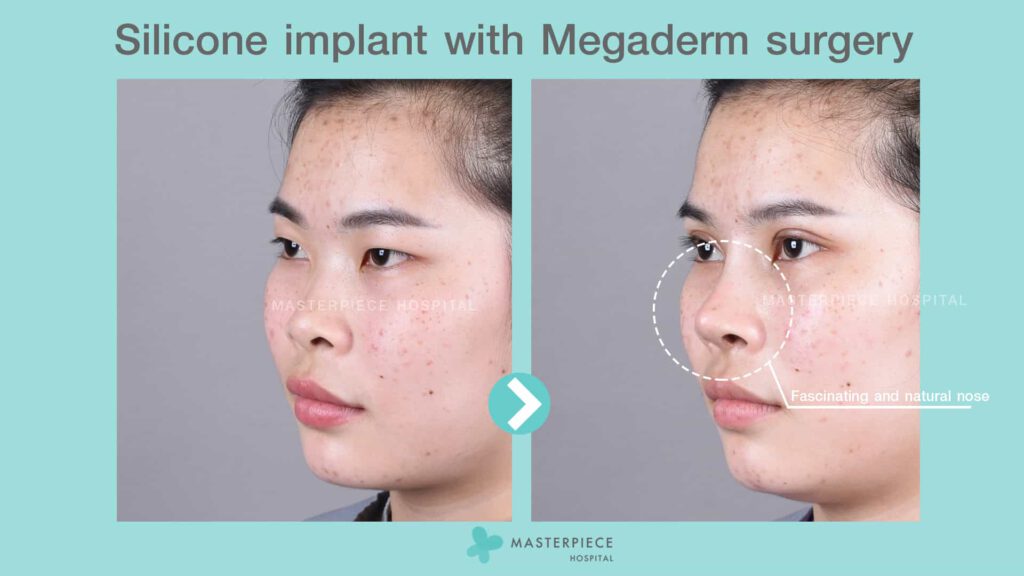 silicone implant with megaderm surgery 2