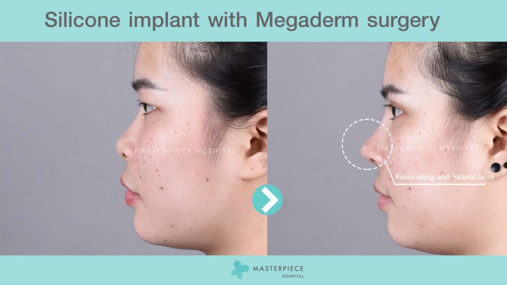 silicone implant with megaderm surgery  1