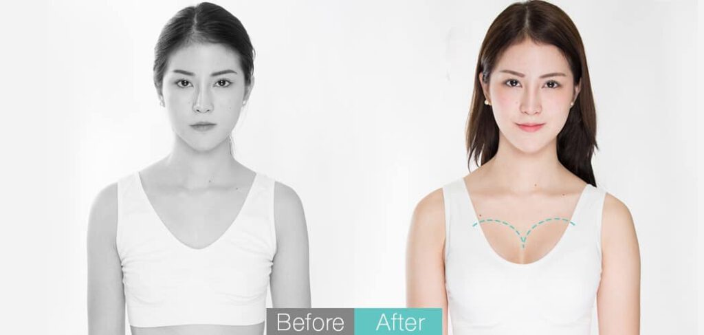 review breast augmentation  (Before-After)