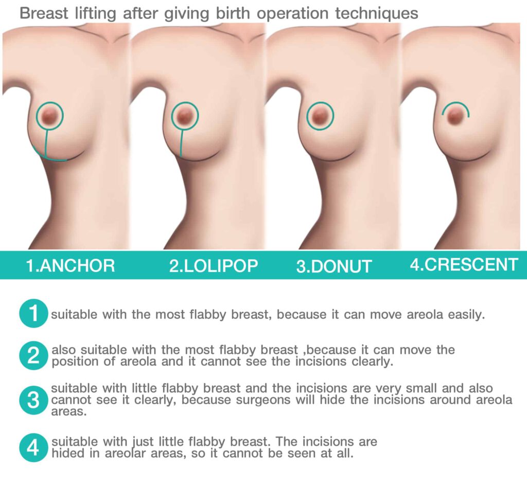 Breast-lifting-after-giving-birth-operation-techniques