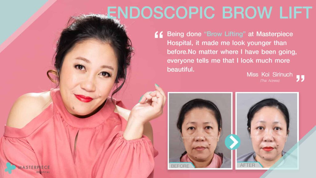 endoscopic brow lift