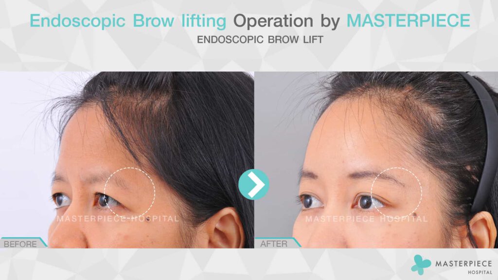 endoscopic brow lifting 1