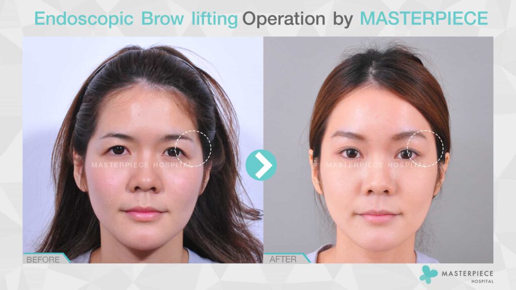 endoscopic brow lifting 3