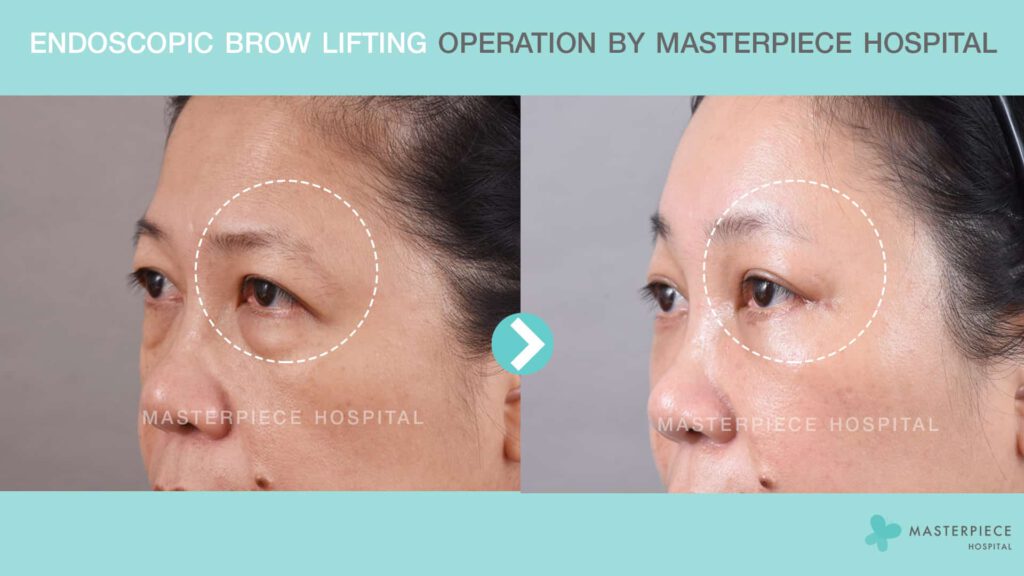 endoscopic brow lifting operationby masteriece hospital