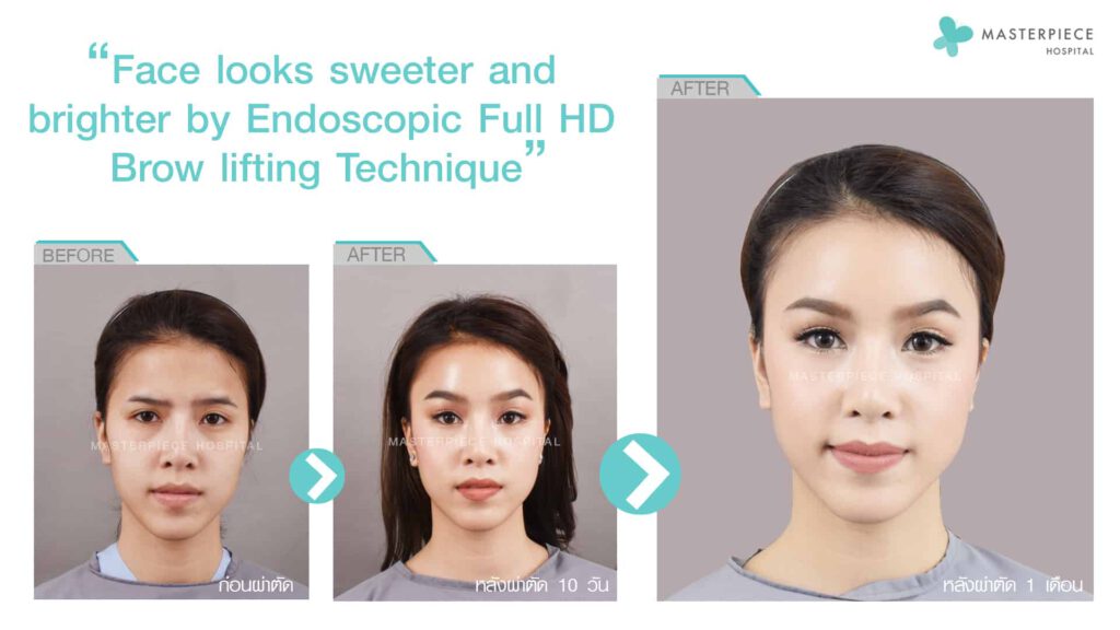 Face looks sweeter and brighter by endoscopic full hd