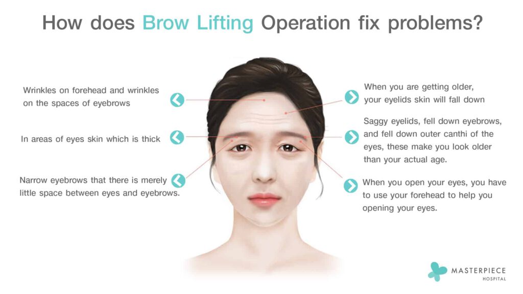 how does brow lifting operation fix problems 
