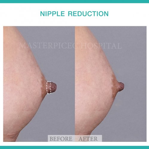 review Nipple reduction 1 