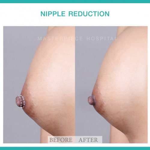 review Nipple reduction 2