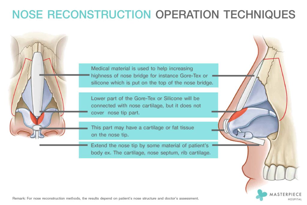 Nose-Reconstruction-Operation-Techniques