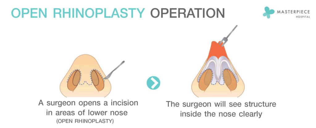 Open-Rhinoplasty-Operation