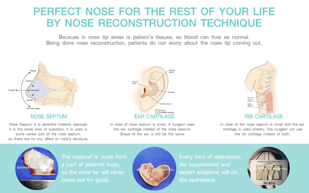 Perfect-nose-for-the-rest-of-your-life-by-Nose-Reconstruction-Technique