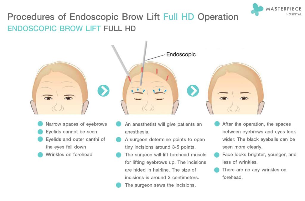 Procedures of Endoscopic brow lift full hd operation endoscopic brow lift full hd
