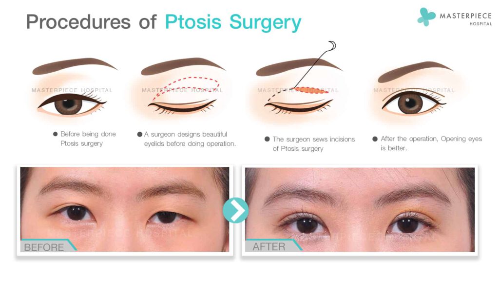 Procedures-of-Ptosis-Surgery