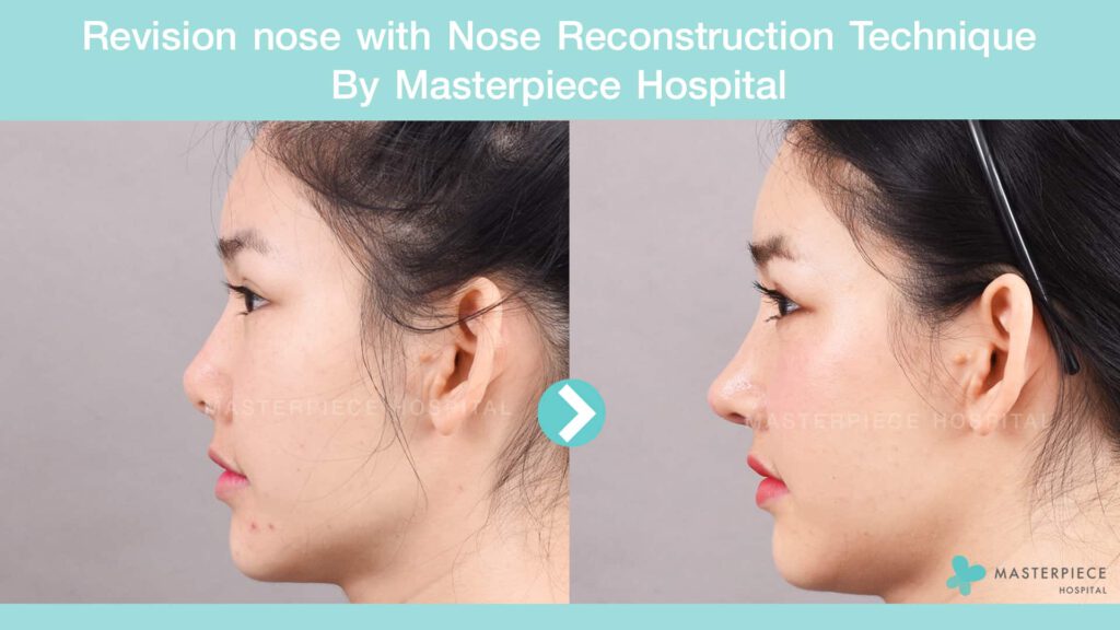 Revision-nose-with-Nose-Reconstruction-Technique-01