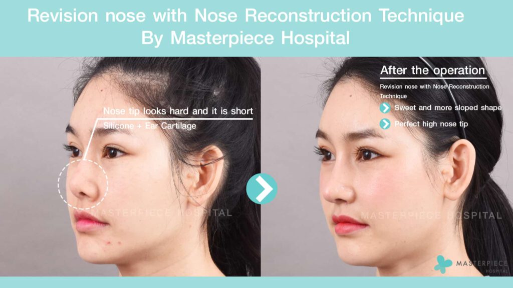 Revision-nose-with-Nose-Reconstruction-Technique-02