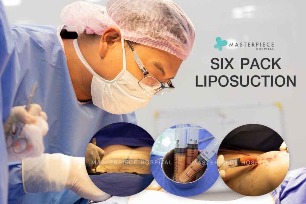 Six-pack-Liposuction