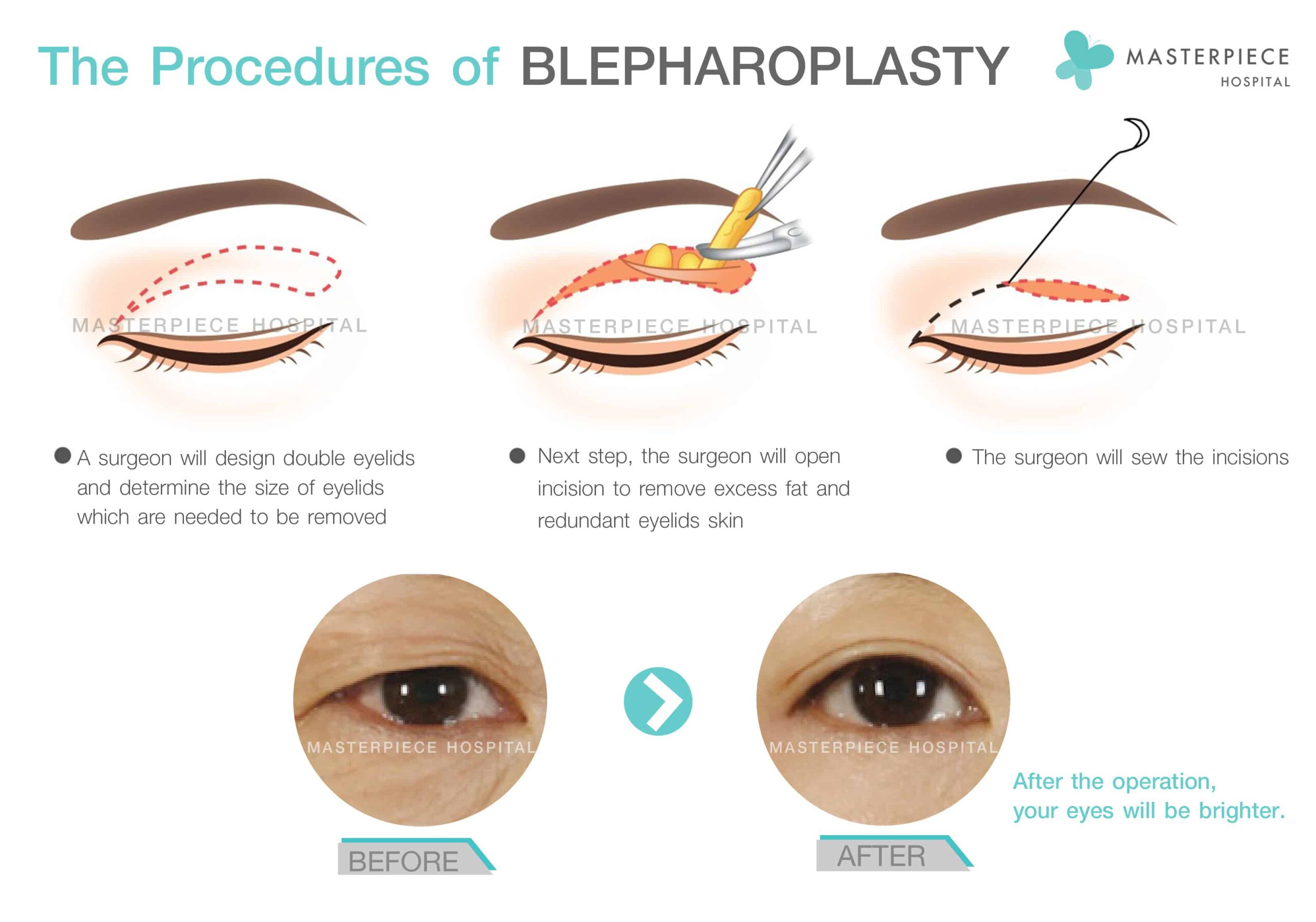 The Procefures of BLEPHOPLASTY 