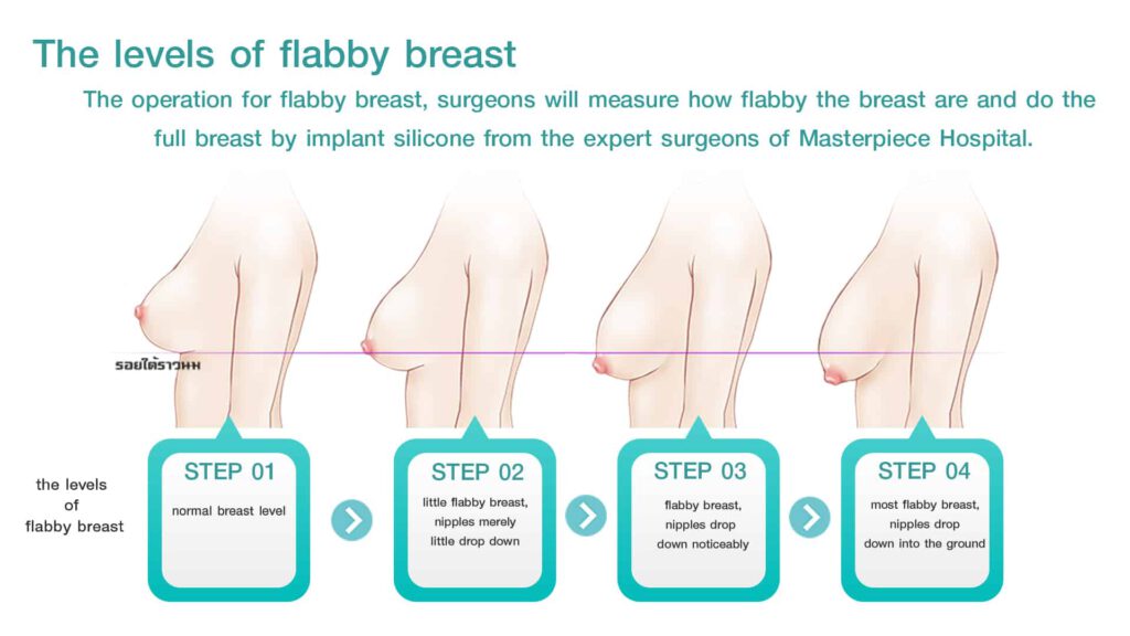 The-levels-of-flabby-breast