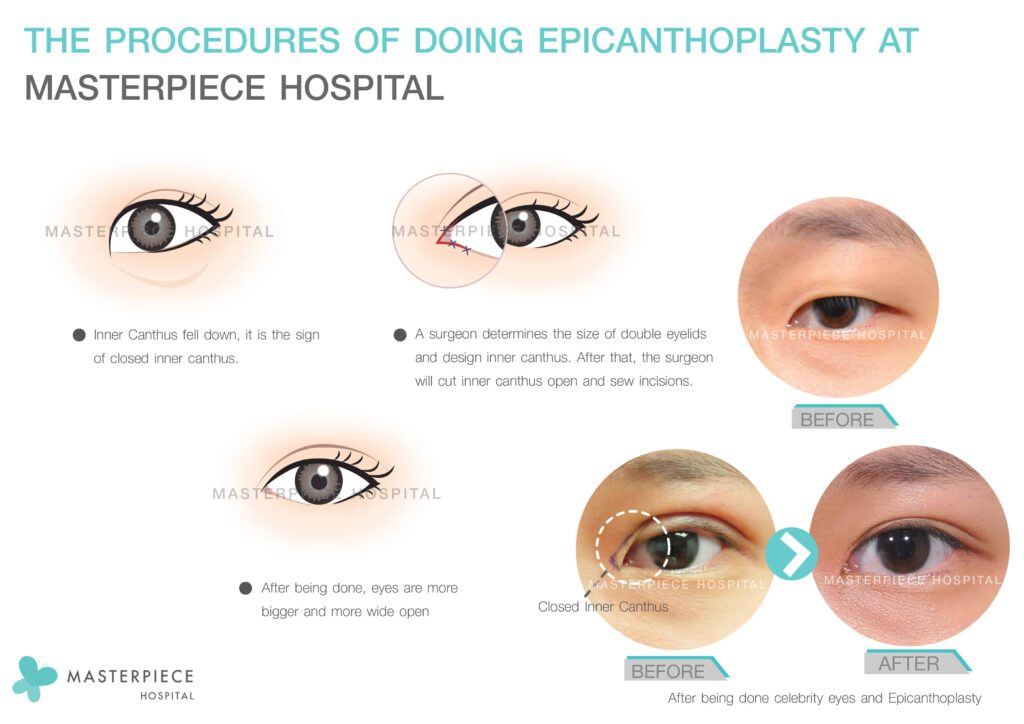 the procedures of doing epicanthoplasty