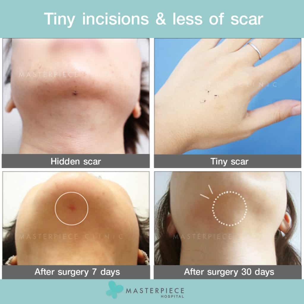 Tiny-incisions-less-of-scar