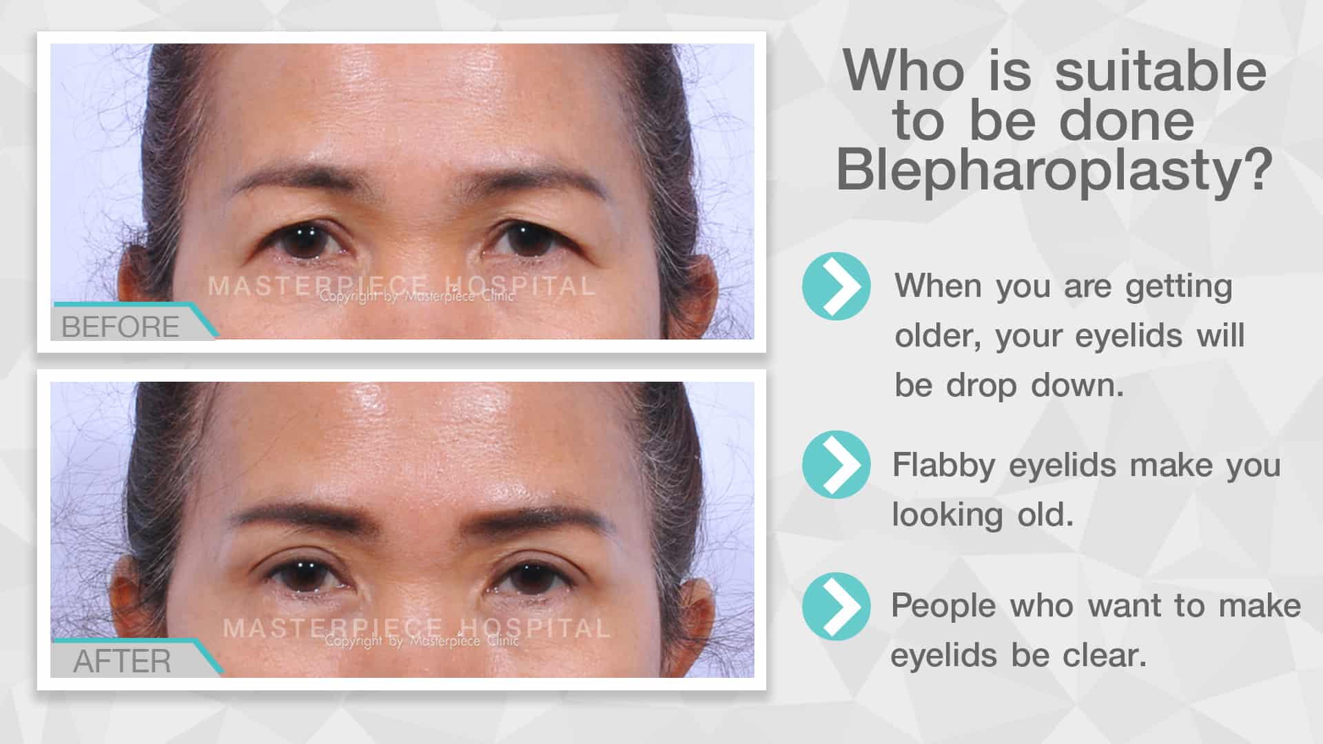 Who is suitable to be done Bleoplasty ?