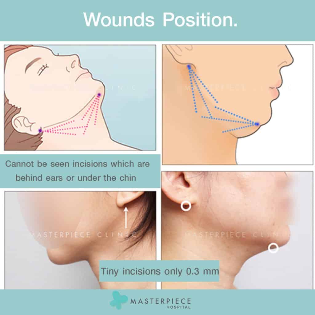Wounds-Position