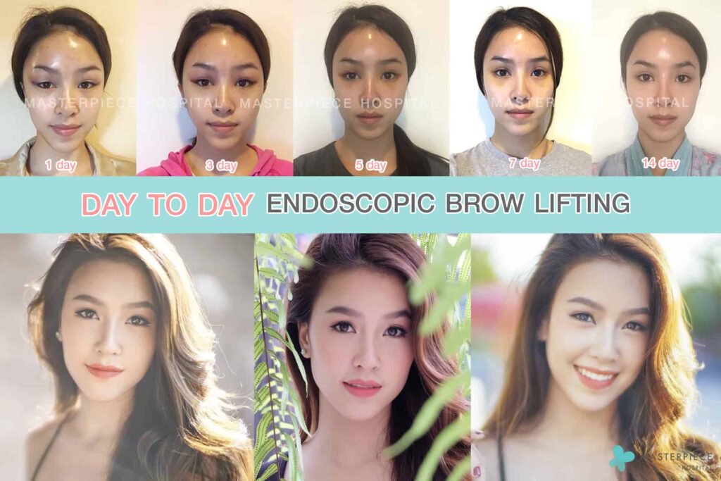 Day to day endoscopic brow liftion