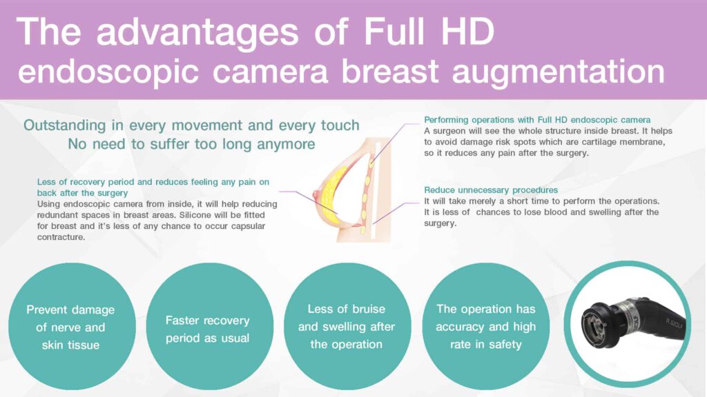 The advantages of Full HD endoscopic camera breast augmeentation 