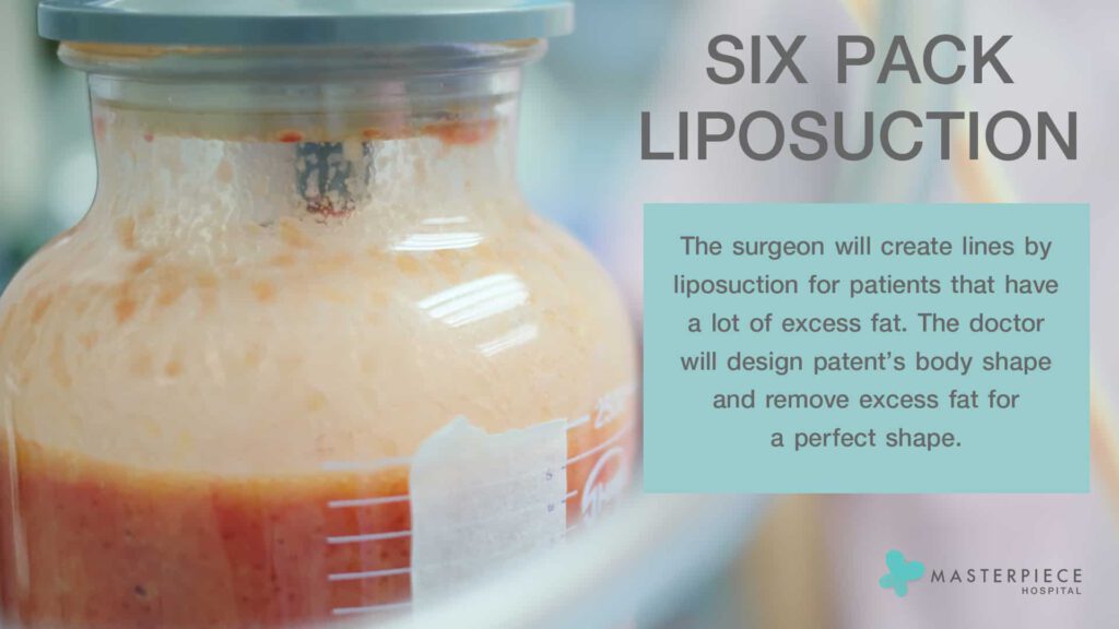 six pack liposuction 