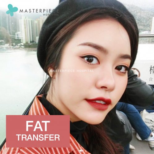 review fat transfer 3