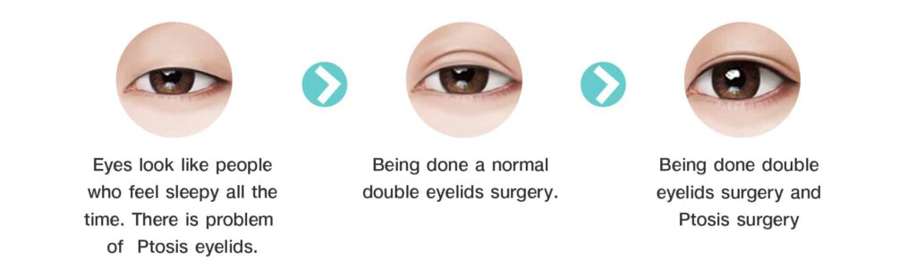 WHAT IS PTOSIS SURGERY