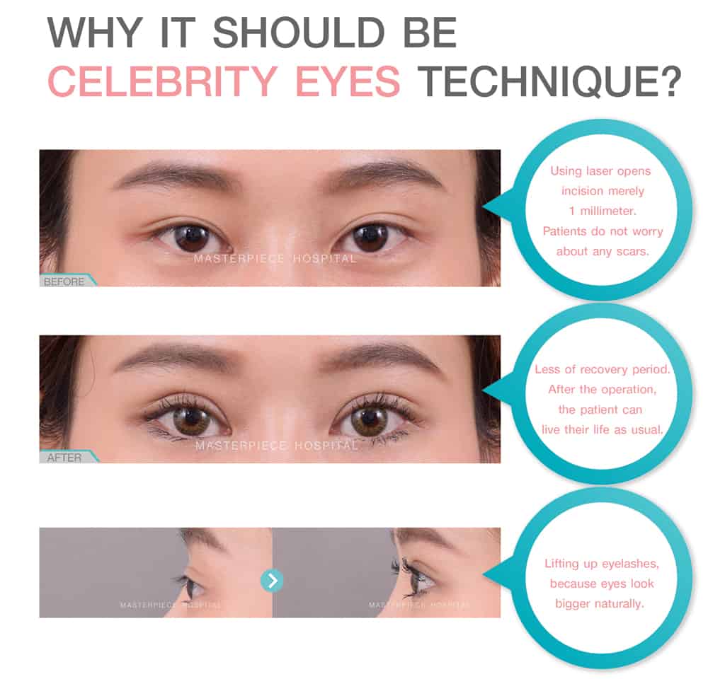 why it should be the celerity eyes technique