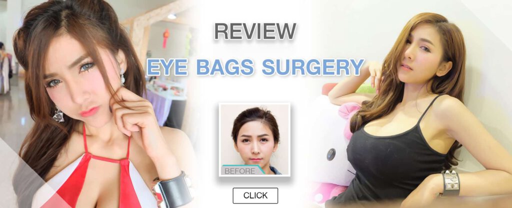 review eye bag surgery 2