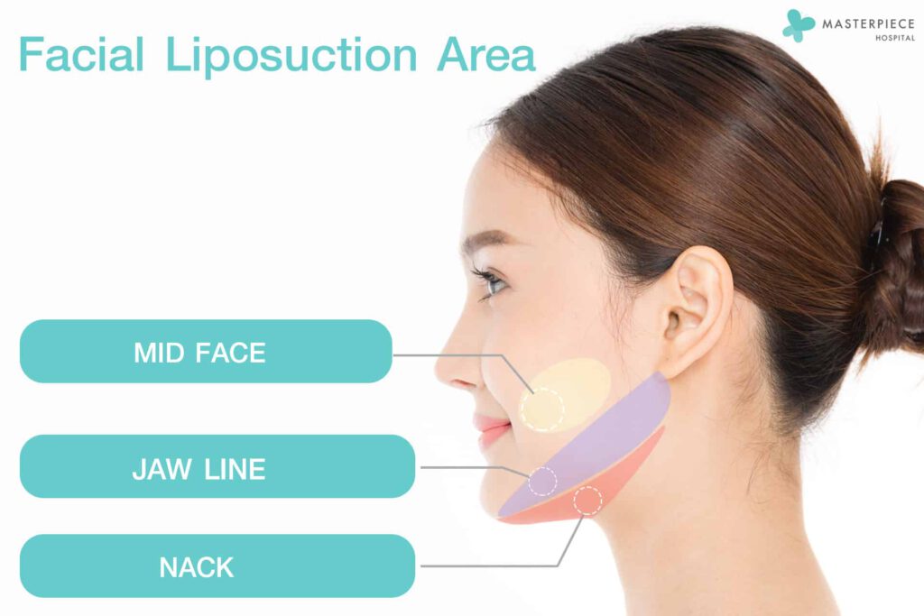 facial liposuction area
