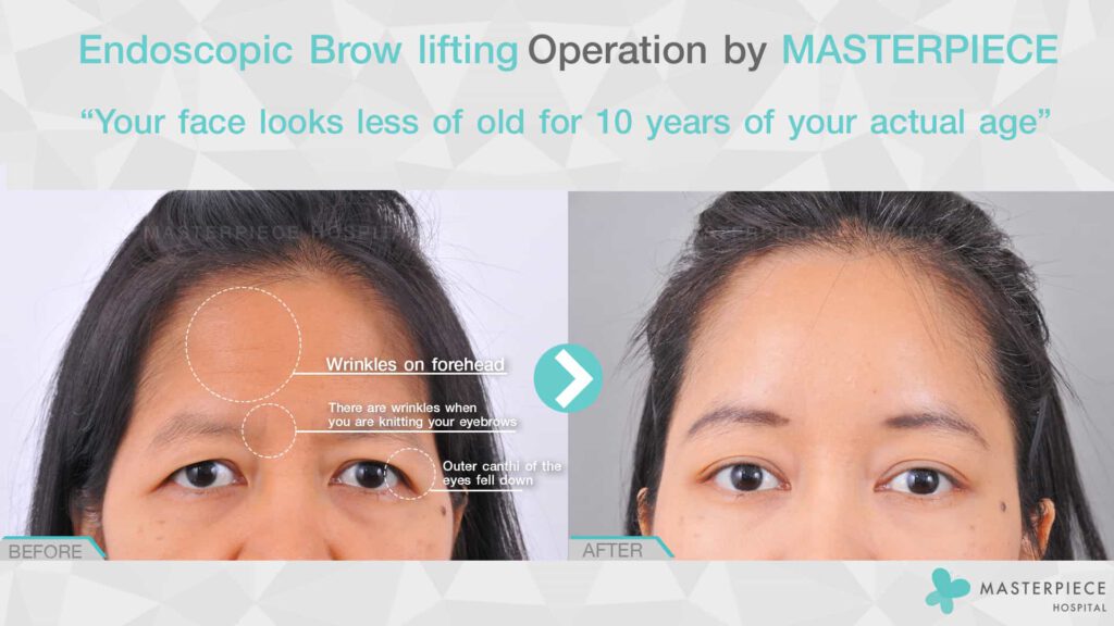 endoscopic brow lifting 2
